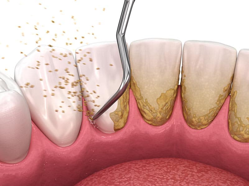 Effective Periodontal Treatments for Strong Gums and Lasting Smiles